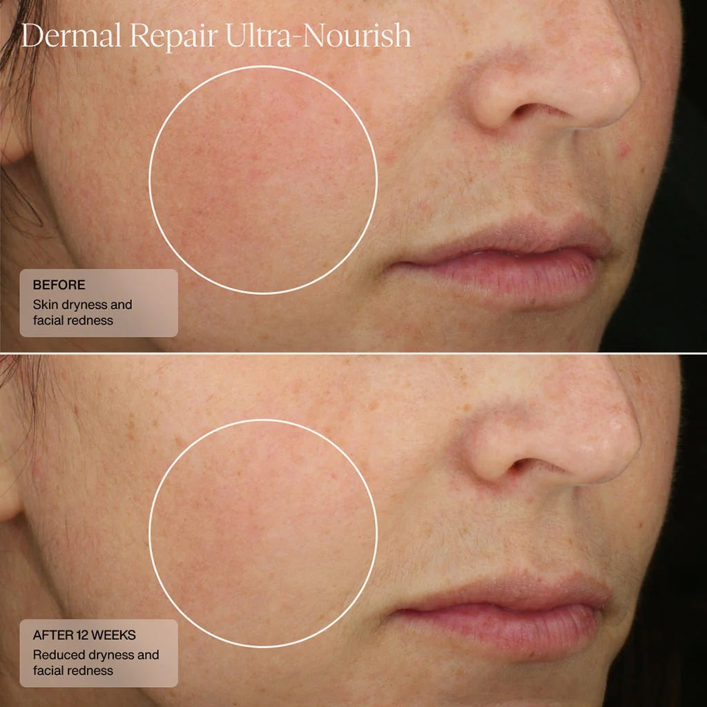 Senté Dermal Repair Ultra-Nourish Rosacea Cream